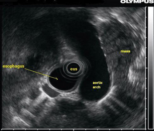 endoscopic ultrasound image of the esophagus