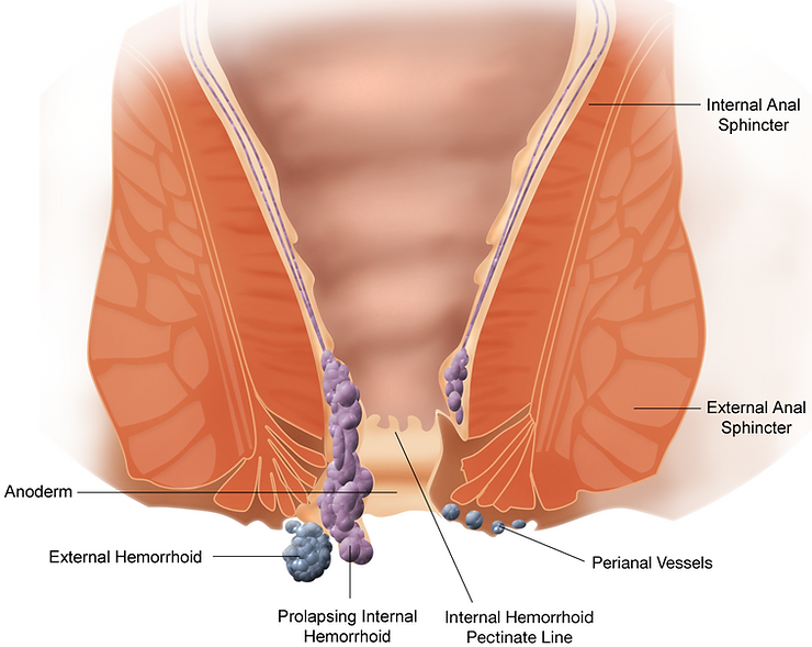 types of hemorrhoids